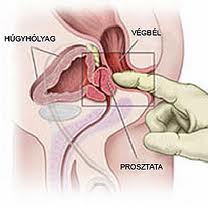 prosztata székelési inger acute and chronic prostatitis icd 10 quizlet