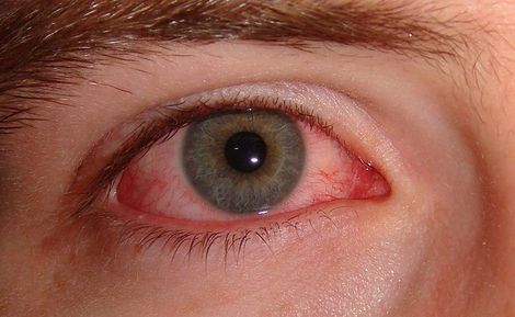 A vörös szemek kialakulása és kezelése