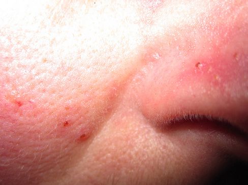 vörös foltok az arcon rosacea vörös foltok a körte kezelési módszerein