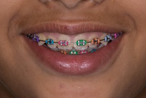 színes fogszabályzók 2