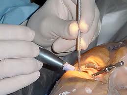 Lézeres szemműtét közben