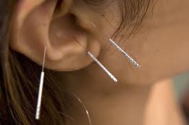 A fül akupuntúrás kezelése