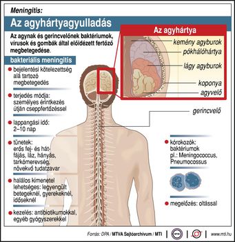 Agyhártyagyulladás