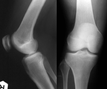 Kétirányú röntgen felvétel