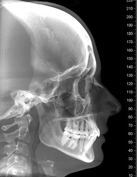 röntgen - fej oldalról
