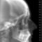 röntgen - fej oldalról