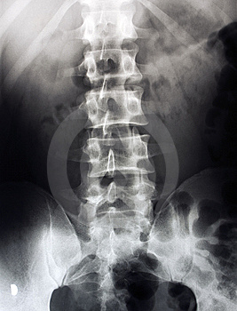 röntgen - gerinc