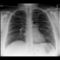 röntgen - mellkas röntgen 1