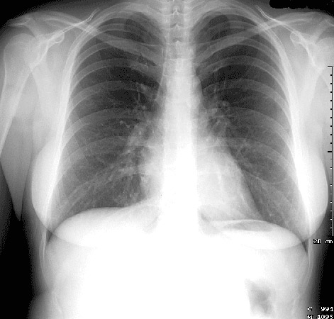 fogyás és mellkas röntgen