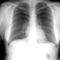 röntgen - mellkas röntgen 2