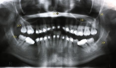 röntgen - panoráma röntgen 2
