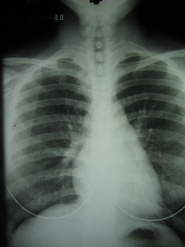 röntgen - tuberkolózis vagy nem?
