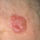 Borbetegsegek__melanoma_425821_85780_t