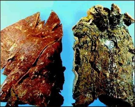 tüdőrák jobb-bal oldal