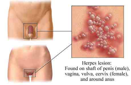 Herpes simplex vírus 2-es típusú