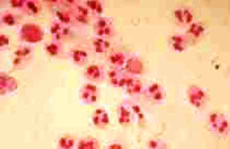 Some_STDS_Nongonococcal_Urethritis-ureaplasma vírus