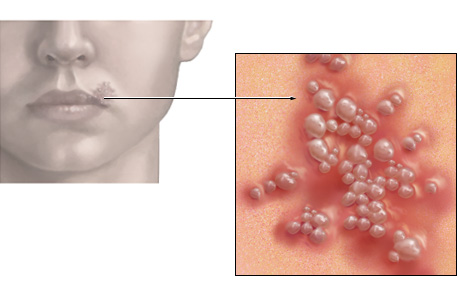 Herpes simplex  3