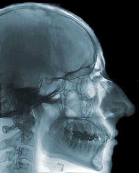 Foghiány röntgenképen