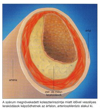 Arterioszklerozis kialakulása. 1