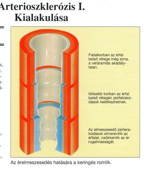 Arterioszklerozis kialakulása. 4