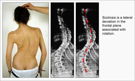 Scoliosis1